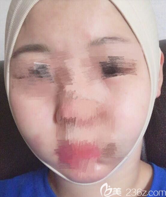 刚做完手术的我 刚做完手术的我