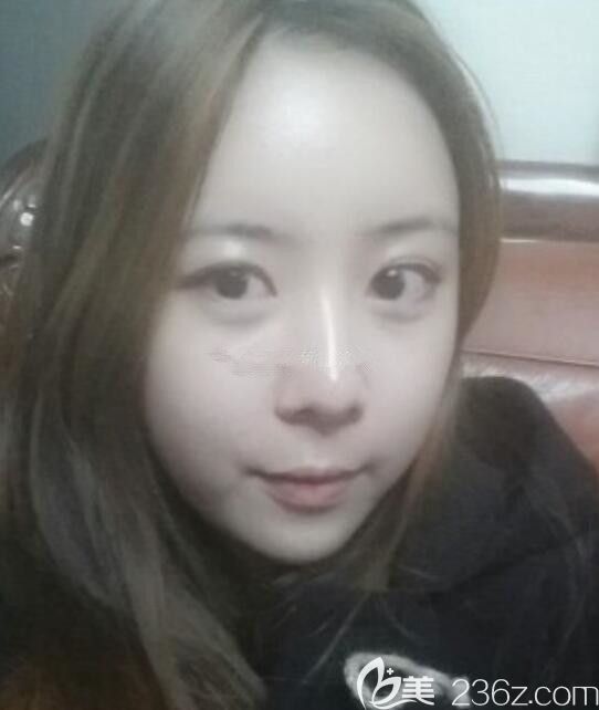 韩国遇见美李承灿骨膜提升吸引我做轮廓 术后一年了过来说说情况