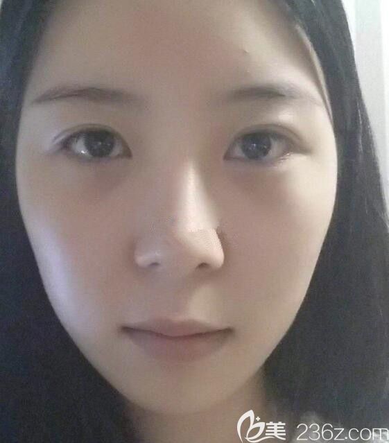 韩国遇见美李承灿做轮廓怎么样 韩国遇见美李承灿做轮廓怎么样