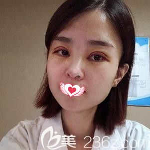 在保定蓝山做眼综合术后7天进行拆线