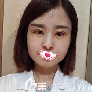 王俭医生为我做眼综合术后18天慢慢消肿