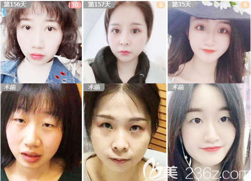 深圳米兰柏羽黎慧娟医生做的双眼皮案例