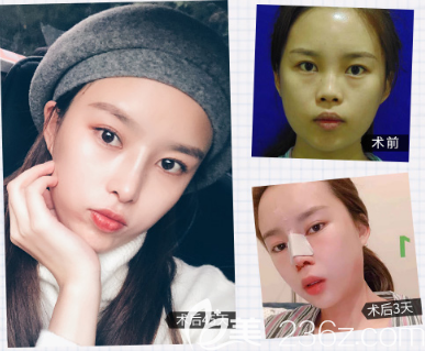 深圳米兰柏羽黎慧娟医生隆鼻手术案例