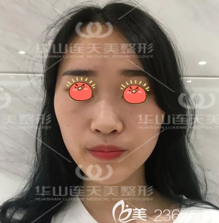 杭州连天美做肋骨鼻手术前 杭州连天美做肋骨鼻手术前