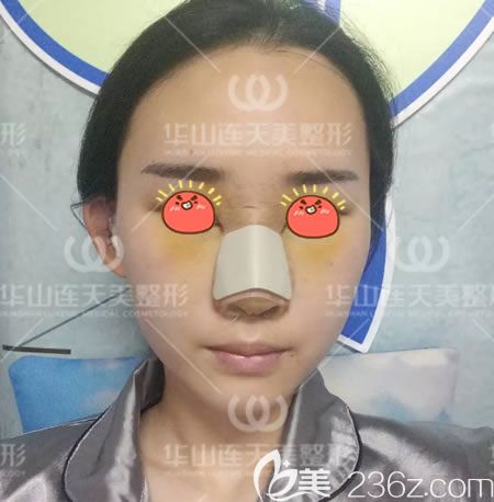 杭州连天美膨体隆鼻即刻效果 杭州连天美膨体隆鼻即刻效果