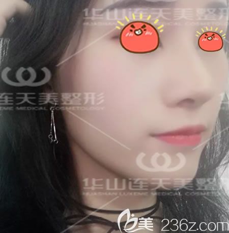 杭州连天美<!--<i data=20240703-sp></i>-->隆鼻案例 杭州连天美<!--<i data=20240703-sp></i>-->隆鼻案例