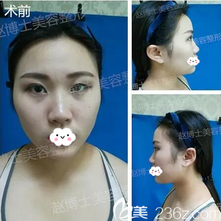 成都军大整形外科医院赵善军术前照片1