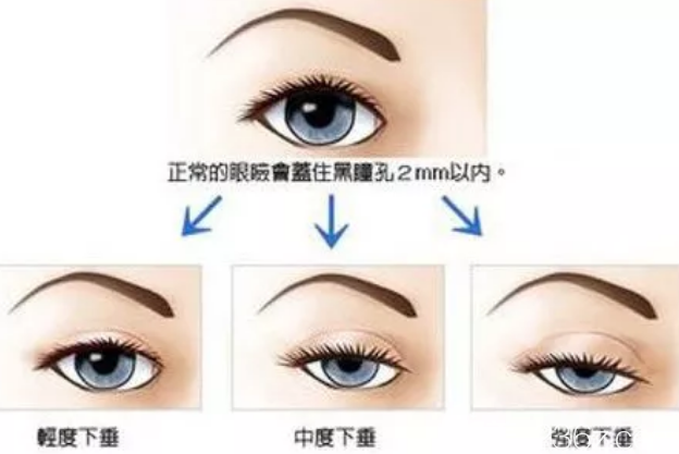 上睑下垂的分类 上睑下垂的分类