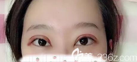 包头叶子<!--<i data=20240703-sp></i>-->全切双眼皮第二天图片