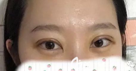 切开双眼皮第五天效果好不好