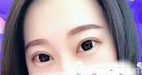 亲身经历后才知道包头叶子做双眼皮怎么样 我还拍了包头叶子整形价格表