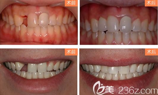 宁波薇琳齿科<!--<i data=20240703-sp></i>-->胜种植牙案例 宁波薇琳齿科<!--<i data=20240703-sp></i>-->胜种植牙案例