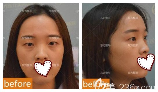 我在南宁东方整形做眼鼻部整形前 我在南宁东方整形做眼鼻部整形前