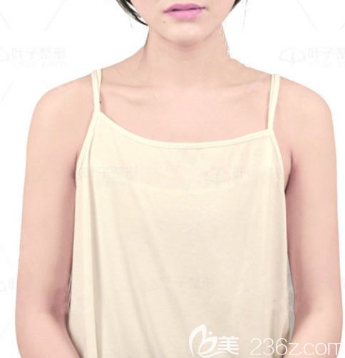 包头叶子整形医院假体隆胸前 包头叶子整形医院假体隆胸前