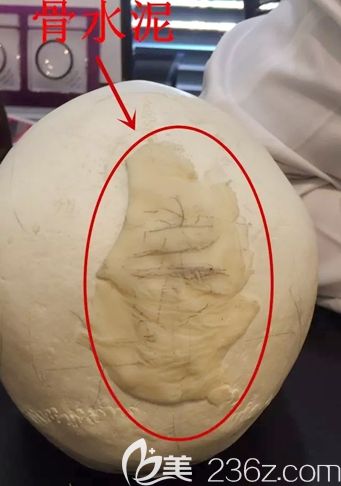 韩国雕刻骨水泥