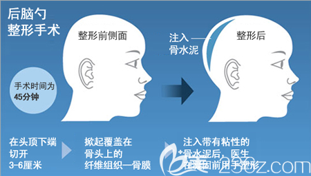 韩国雕刻骨水泥填充后脑勺过程