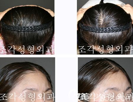 韩国雕刻骨水泥填充案例