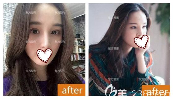  原本只是找南宁东方整形院长做肋软骨鼻综合隆鼻,面诊后又加了全切双眼皮