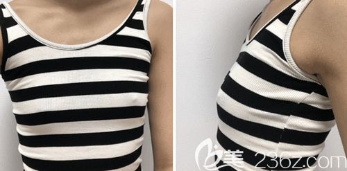 在韩国玛博尔做假体隆胸手术前 在韩国玛博尔做假体隆胸手术前