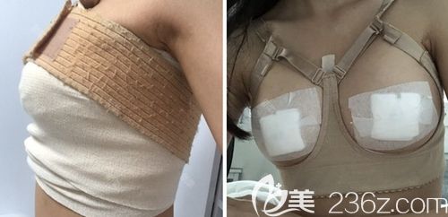 在韩国玛博尔做假体隆胸手术当天 在韩国玛博尔做假体隆胸手术当天