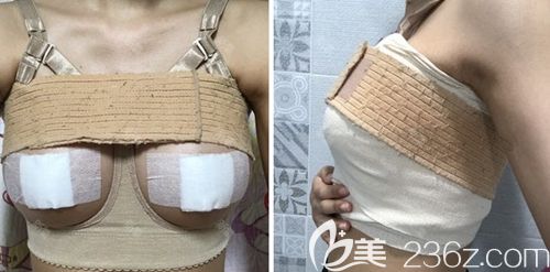 在韩国玛博尔做假体隆胸手术后2周 在韩国玛博尔做假体隆胸手术后2周