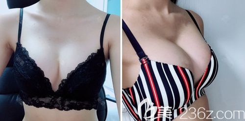 在韩国玛博尔做假体隆胸手术后3个月 在韩国玛博尔做假体隆胸手术后3个月