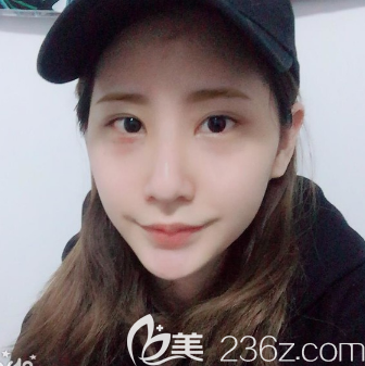 广州紫馨谷琪祛眼袋术后三天 广州紫馨谷琪祛眼袋术后三天