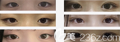 韩国乐于丽颜韩式双眼皮案例 韩国乐于丽颜韩式双眼皮案例
