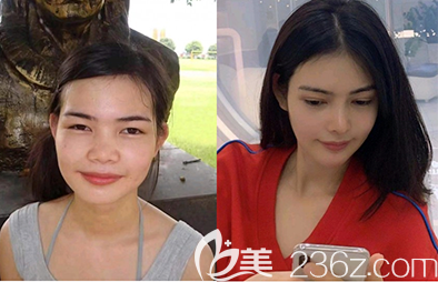 韩国乐于丽颜整形外科韩式隆鼻照片对比图 韩国乐于丽颜整形外科韩式隆鼻照片对比图