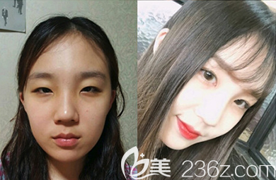 韩国乐于丽颜整形外科继民石韩式无痕双眼皮案例 韩国乐于丽颜整形外科继民石韩式无痕双眼皮案例