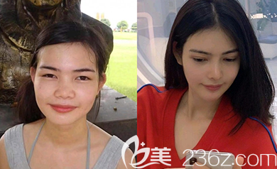 韩国乐于丽颜金范镇院长韩式隆鼻案例效果对比图 韩国乐于丽颜金范镇院长韩式隆鼻案例效果对比图