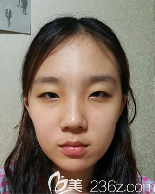 韩国乐于丽颜整形做的眼综合案例 韩国乐于丽颜整形做的眼综合案例