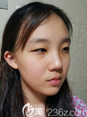 在韩国乐于丽颜整形医院做韩式双眼皮术前面诊 在韩国乐于丽颜整形医院做韩式双眼皮术前面诊