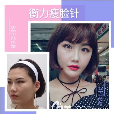 打瘦脸怎么样 打瘦脸怎么样