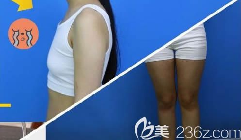 在长春中妍奥拉克吸脂和丰胸术前照 在长春中妍奥拉克吸脂和丰胸术前照