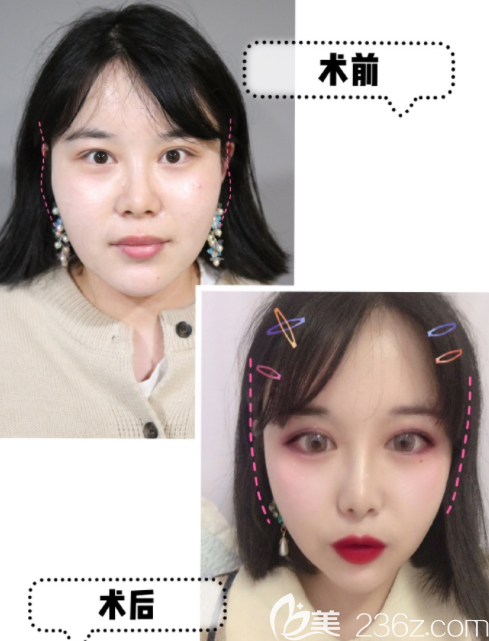 韩国宝士丽玻尿酸丰太阳穴真人案例 韩国宝士丽玻尿酸丰太阳穴真人案例