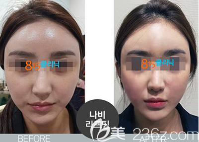 韩国815抗衰老面部提升前后效果对比图