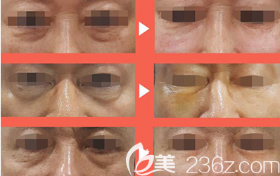 韩国815抗衰老眼袋治疗前后照片