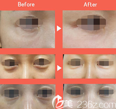 韩国815抗衰老眼袋治疗前后照片 韩国815抗衰老眼袋治疗前后照片