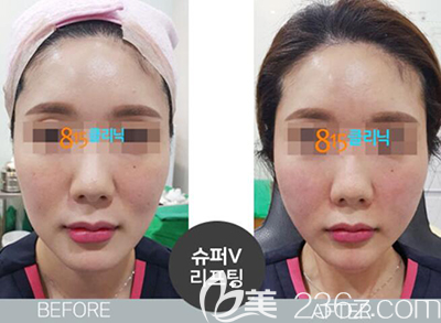 韩国815抗衰老面部提升案例效果前后对比图 韩国815抗衰老面部提升案例效果前后对比图