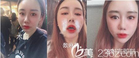 韩国宝士丽玻尿酸填充真人案例 韩国宝士丽玻尿酸填充真人案例