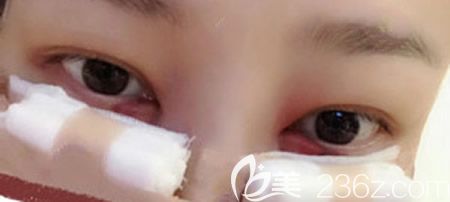 找赣州韩美整形吴彩霞做激光不开刀去眼袋术后第1天效果