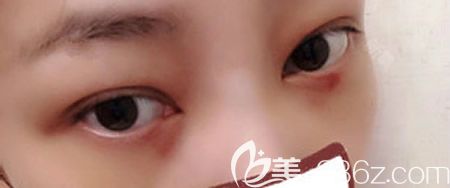 找赣州韩美整形吴彩霞做不开刀去眼袋术后第3天效果