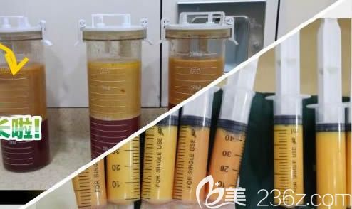 中妍奥拉克大腿环吸出来的脂肪图 中妍奥拉克大腿环吸出来的脂肪图