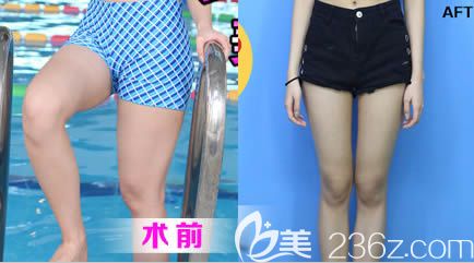 长春奥拉克做大腿吸脂前后对比图 长春奥拉克做大腿吸脂前后对比图