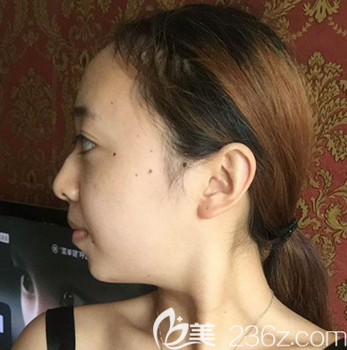 在湛<!--<i data=20240703-sp></i>-->美做隆鼻前的样子 在湛<!--<i data=20240703-sp></i>-->美做隆鼻前的样子