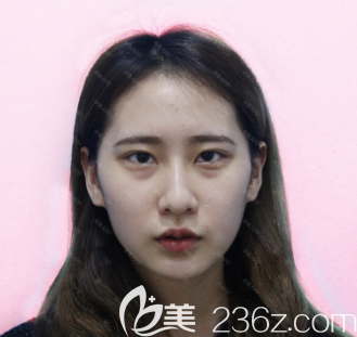 在广州紫馨做祛眼袋手术前的样子 在广州紫馨做祛眼袋手术前的样子