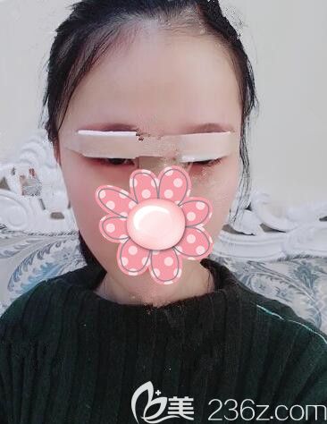 刚做完韩式精切双眼皮术后即刻眼部肿胀