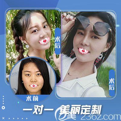 石家庄蓝山注射玻尿酸案例 石家庄蓝山注射玻尿酸案例