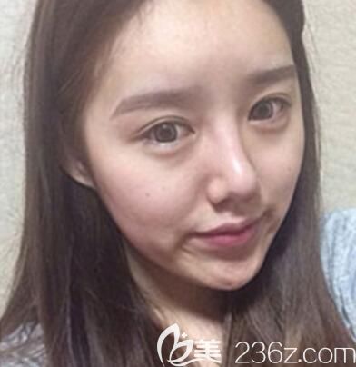 韩国id整形医院纳米脂肪移植+面部提升+颧骨降低案例 韩国id整形医院纳米脂肪移植+面部提升+颧骨降低案例